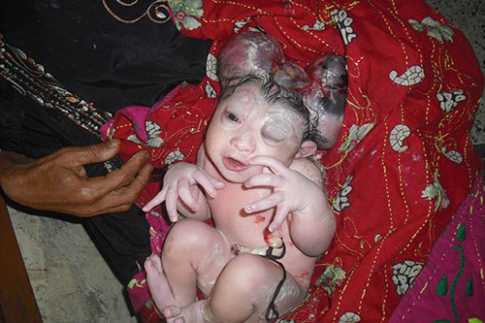 ভোলায় তিন মাথাওয়ালা শিশুর জন্ম