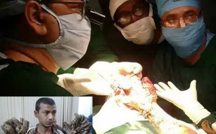 বৃক্ষমানবের ডান হাতে অস্ত্রোপচার