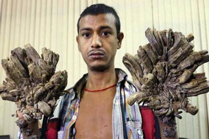 বৃক্ষমানব আবুলের দ্বিতীয় অস্ত্রোপচার সম্পন্ন