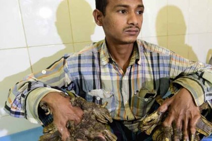 ট্রি-ম্যানের হাতের ড্রেসিং সম্পন্ন