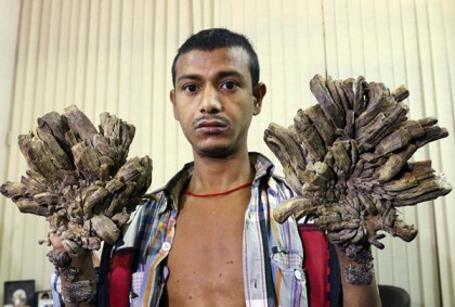 ট্রিম্যানের বাম হাতে অস্ত্রোপচার চলছে