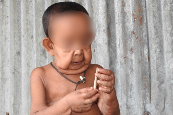 ঢাকায় পাঠানো হচ্ছে সেই 'বৃদ্ধ' শিশুকে