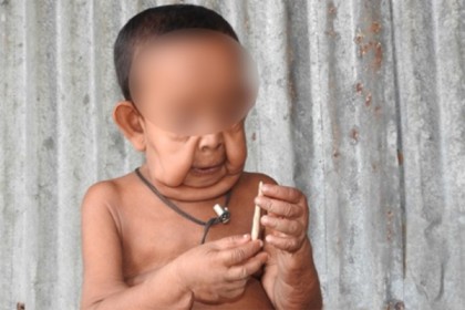 ঢাকায় পাঠানো হচ্ছে সেই 'বৃদ্ধ' শিশুকে