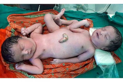 ভারতে এক শরীরে দুই মাথার বিরল যমজের জন্ম