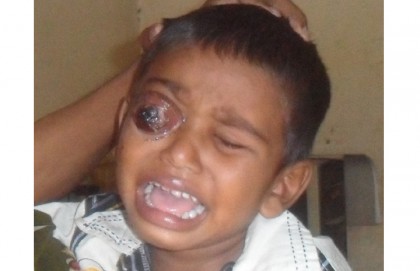 পুষ্টির অভাবে দু'চোখ হারাতে বসেছে শিশু সামিউল