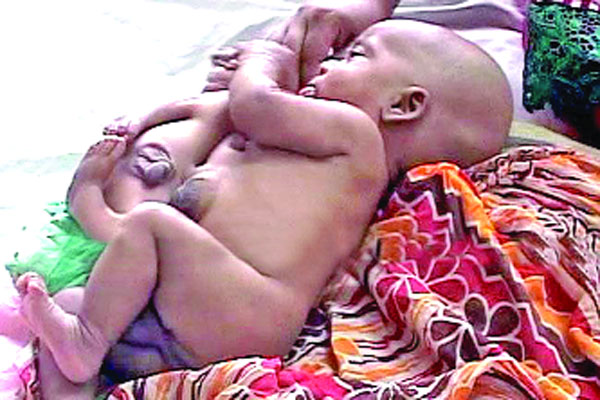 আলাদা হলো যমজ শিশু