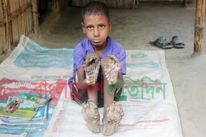 ঠাকুরগাঁওয়ে আরও এক 'বৃক্ষ মানব'র সন্ধান!