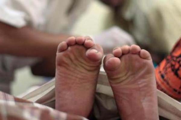 খতনার পর দুই কিশোরীর মৃত্যু