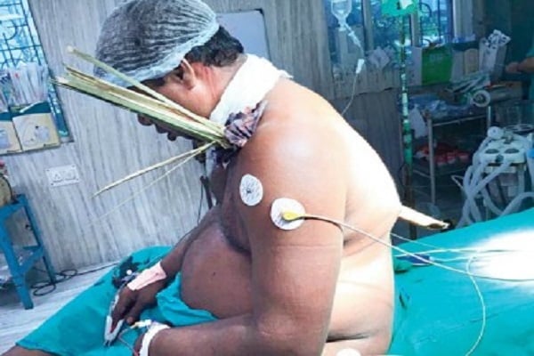 বুকে বিদ্ধ বাঁশের টুকরোটি অবশেষে উদ্ধার
