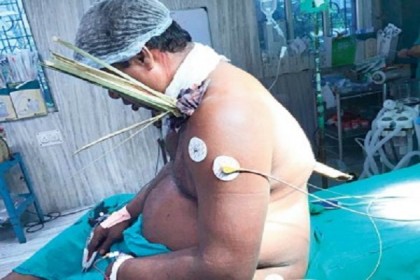 বুকে বিদ্ধ বাঁশের টুকরোটি অবশেষে উদ্ধার