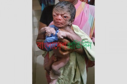 সুস্থ আছে সেই 'বৃদ্ধ' শিশুটি