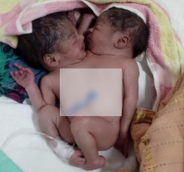 হাসপাতালে জোড়া লাগানো শিশু রেখে চলে গেলেন স্বজনরা