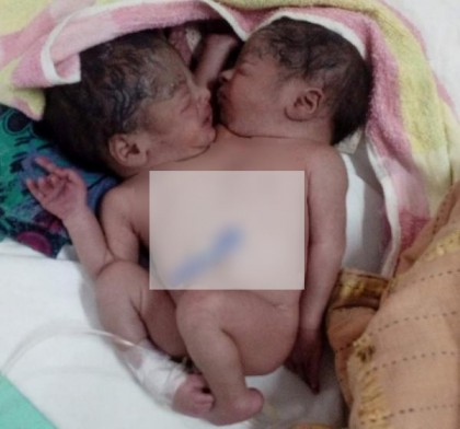 হাসপাতালে জোড়া লাগানো শিশু রেখে চলে গেলেন স্বজনরা