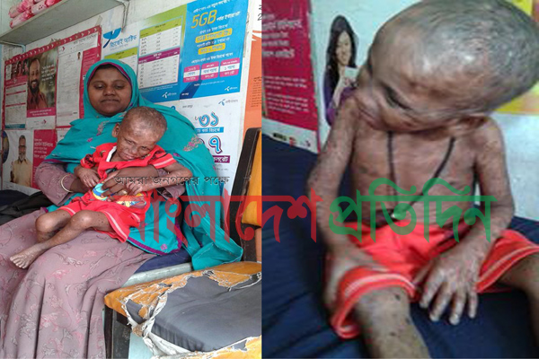 অজ্ঞাত রোগে আক্রান্ত শিশু, দিশেহারা বাবা-মা