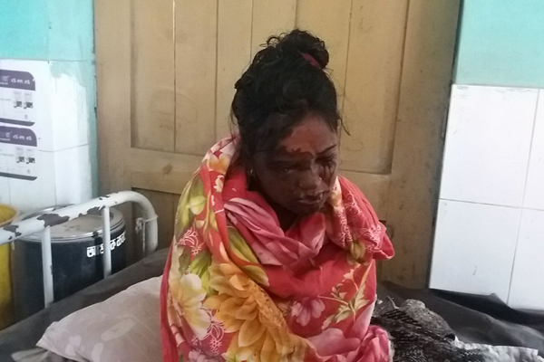 স্ত্রীকে এসিডে ঝলসে দিলেন স্বামী