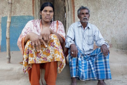 ৯ ফুট উচ্চতার মেয়ে নিয়ে বিপাকে বাবা