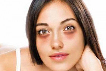 যেভাবে দূর করবেন চোখের নিচের কালি