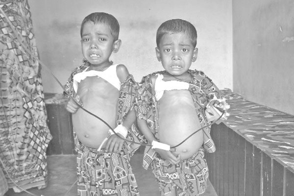 বরগুনায় ‘থ্যালাসেমিয়া’ আক্রান্ত দুই সহোদর