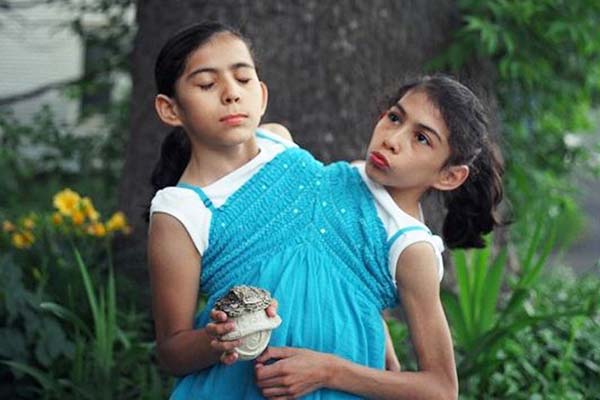 দুই বোন এক দেহে ১৬ বছর ধরে!