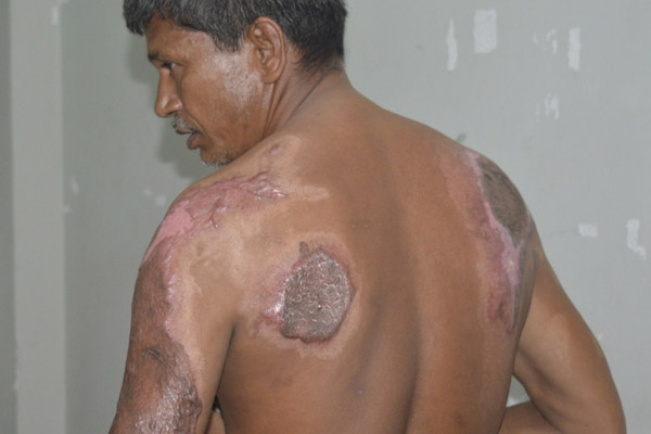 মামলা ভিন্ন খাতে প্রবাহের চেষ্টা, দিনাজপুরে এসিডদগ্ধের অভিযোগ