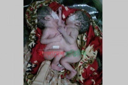 চুয়াডাঙ্গায় জোড়া লাগানো জমজ শিশুর জন্ম 
