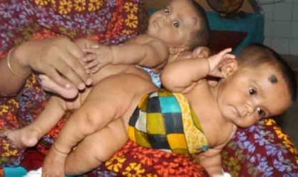 তোফা-তহুরাকে আলাদা করার অস্ত্রোপচার শুরু