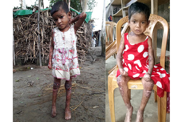 অজ্ঞাত রোগে আক্রান্ত শিশু মাহমুদা এখন ঢাকায়