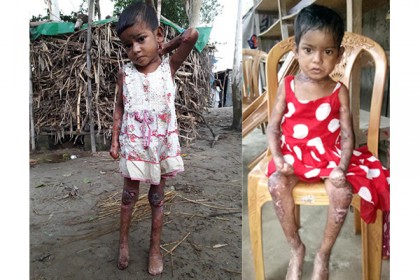 অজ্ঞাত রোগে আক্রান্ত শিশু মাহমুদা এখন ঢাকায়