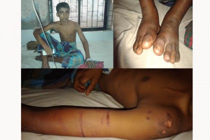 পায়ে সুচ ঢুকিয়ে কিশোরকে ১৬ ঘণ্টা নির্যাতন 