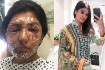অ্যাসিড হামলার ৩ মাস পর আগের চেহারায় ফিরলেন মডেল কন্যা!
