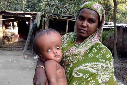 হাইড্রোসেফালাস রোগে আক্রান্ত নওগাঁর সাইদ