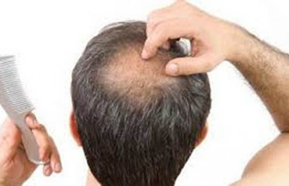 চুল পড়ে যাচ্ছে: ঘরোয়া সমাধান