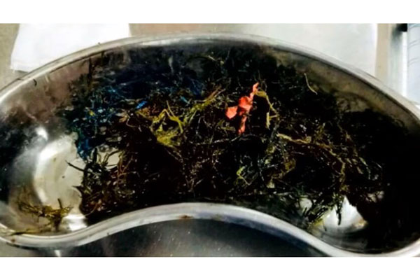 কিশোরের পাকস্থলী থেকে বের হলো ১ কেজি প্লাস্টিক!