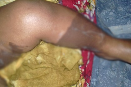 সাপ তাড়ানোর কার্বোলিক এসিডে শিশু দগ্ধ