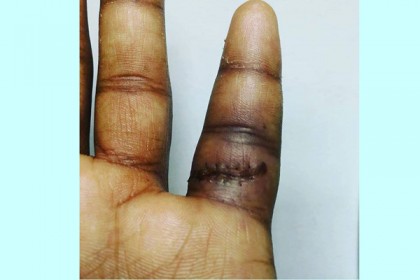 সাকিবের সেলাই জর্জরিত ও রক্ত জমাটবাঁধা আঙুল