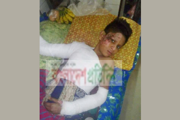 গরম পানি ঢেলে শিশু গৃহকর্মীকে পুড়িয়ে নির্যাতন