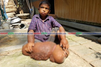 বিরল রোগে দিশেহারা পরিবার, বিনা চিকিৎসায় একজনের মৃত্যু