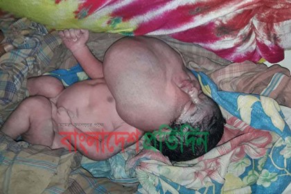 পঞ্চগড়ে সিস্টিক হাইগ্রোমা শিশুর জন্ম 