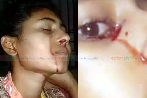 বিরল রোগে আক্রান্ত মেধাবী ছাত্রী জিনাত

