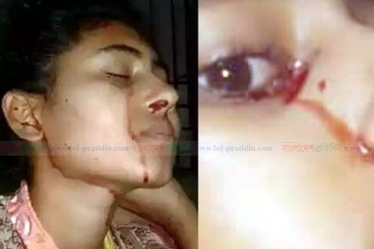 বিরল রোগে আক্রান্ত মেধাবী ছাত্রী জিনাত

