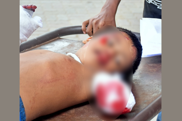 টাকার অভাবে বাবার দেখা পাচ্ছে না হাত হারানো সুমি