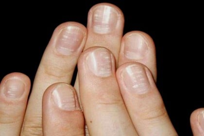 নখ দেখে রোগ চেনায় উপায়