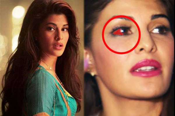 সারাজীবন চোখের ক্ষত বয়ে বেড়াতে হবে জ্যাকুলিনকে