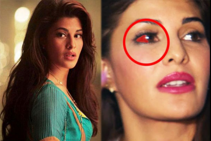 সারাজীবন চোখের ক্ষত বয়ে বেড়াতে হবে জ্যাকুলিনকে