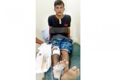 ভুল চিকিৎসার কারণে কুমিল্লায় পা হারাতে বসেছে শিক্ষার্থী 

