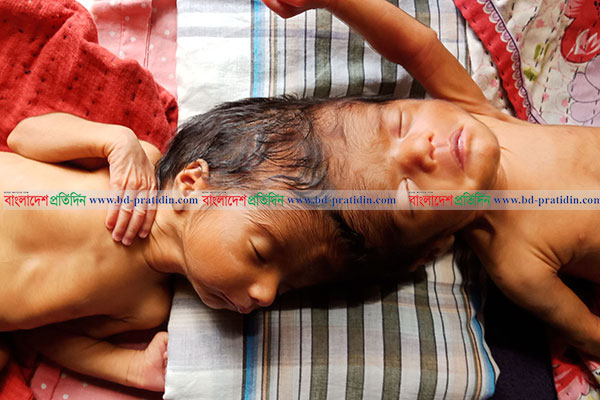 শেরপুরে মাথা জোড়া লাগানো যমজ শিশুর জন্ম, উৎসুক জনতার ভিড়