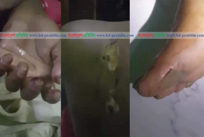 বংশালে গৃহকর্মীকে নির্মমভাবে নির্যাতন, আইসিইউতে কিশোরী (ভিডিও)