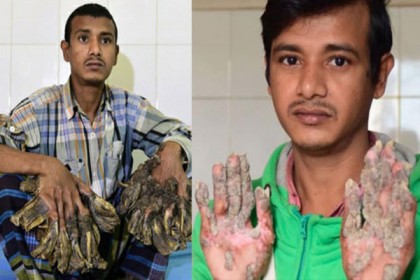 ফের হাতে পায়ে শেকড়, হাসপাতালে বৃক্ষমানব 