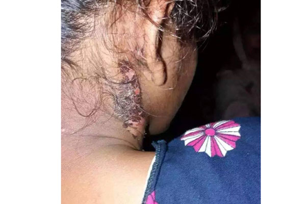মাদারীপুরে স্কুলছাত্রীকে গরম খুন্তির ছেঁকা, সৎ মা ও ভাই আটক

