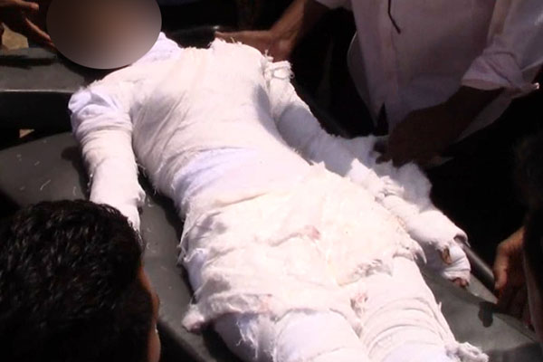 ঢামেকের আইসিইউতে দগ্ধ সেই ছাত্রী, অবস্থা আশঙ্কাজনক